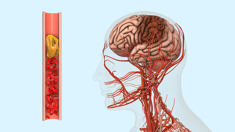 Artemed Fachklinik München Phlebologie Schlaganfall Hirnthrombose